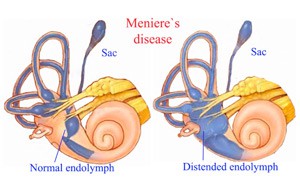 menieres